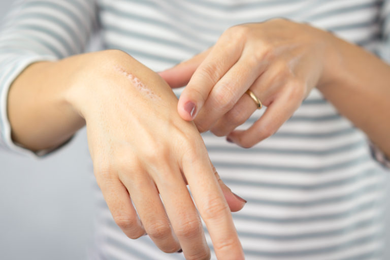 Close up of cooking oil burn scar on a woman's hands. The skin damage in first-degree on outer layer skin. Healing, Removal, Treatment, Accident in the kitchen, Scar, Scald, Wound Healing concept.